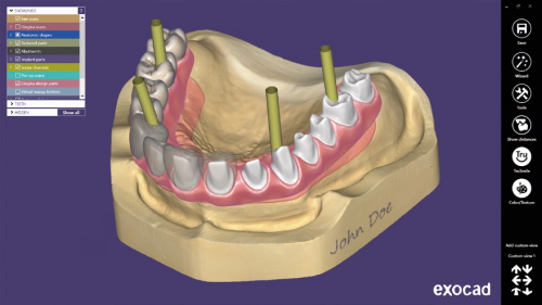 Модуль Exocad Implant module. Имплант модуль