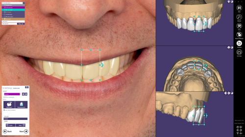 Модуль Exocad Smile Creator. Модуль планирования улыбки